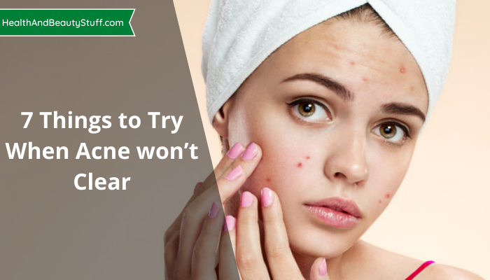 7 Things to Try When Acne won’t Clear