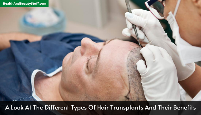 A Look At The Different Types Of Hair Transplants And Their Benefits