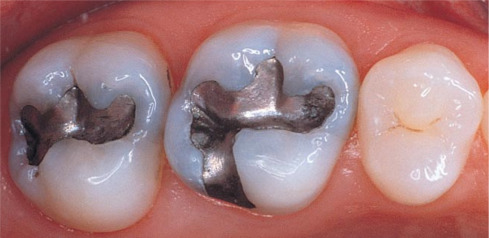 Amalgam dental filling