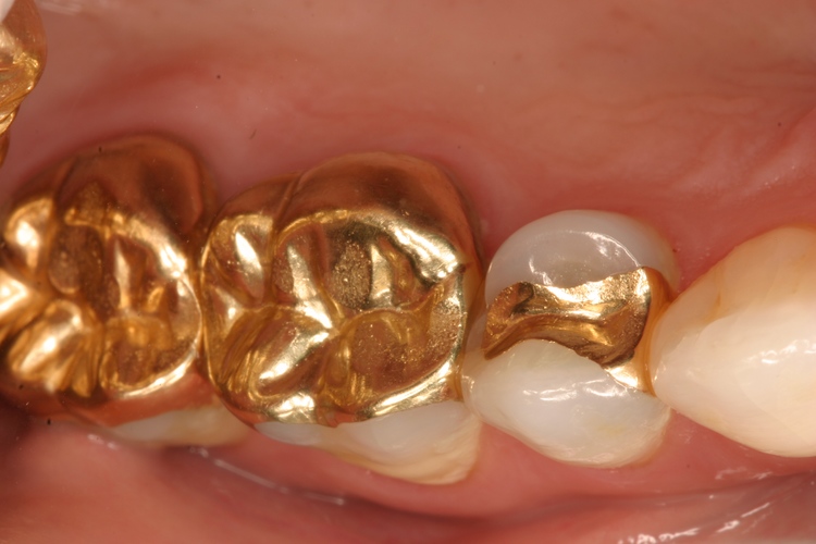 Cast Gold dental filling