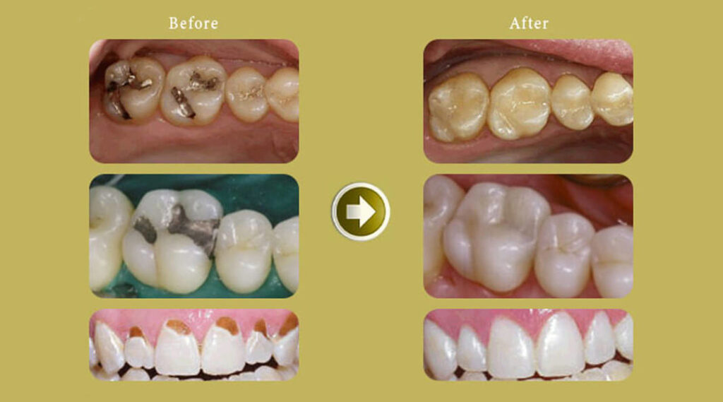 Composite Resin dental filling