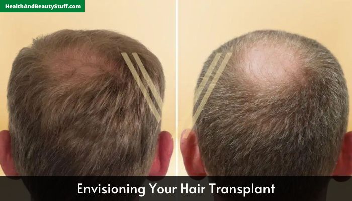 Envisioning Your Hair Transplant