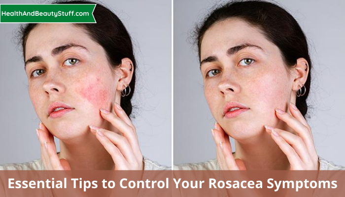 Essential Tips to Control Your Rosacea Symptoms