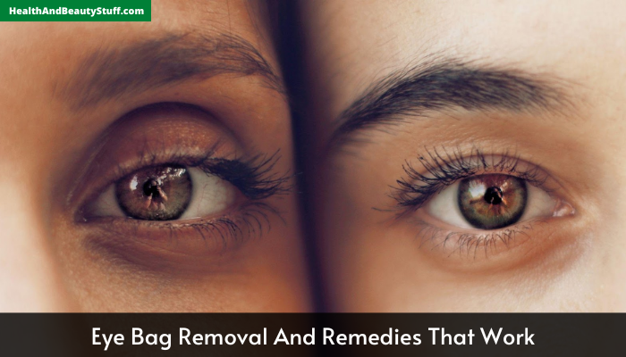 Eye Bag Removal And Remedies That Work