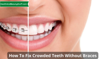 How To Fix Crowded Teeth Without Braces
