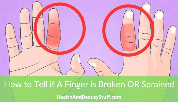 How to Tell if A Finger is Broken OR Sprained