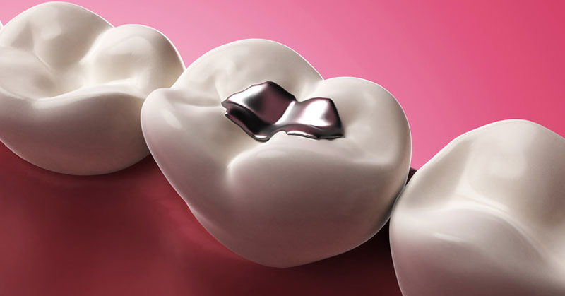 Porcelain dental filling