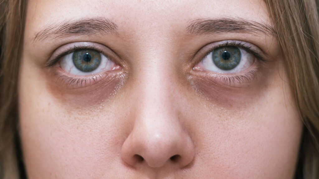 Reasons Behind Dark Circles Under Your Eyes