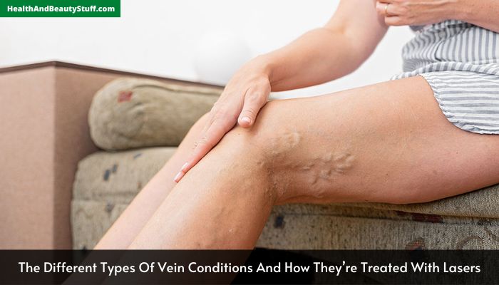 The Different Types Of Vein Conditions And How They’re Treated With Lasers