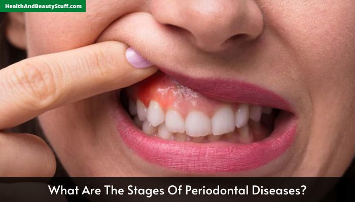 What Are The Stages Of Periodontal Diseases
