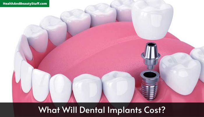 What Will Dental Implants Cost