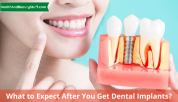 What to Expect After You Get Dental Implants