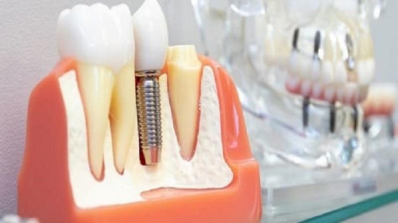 How is dental implant price calculated