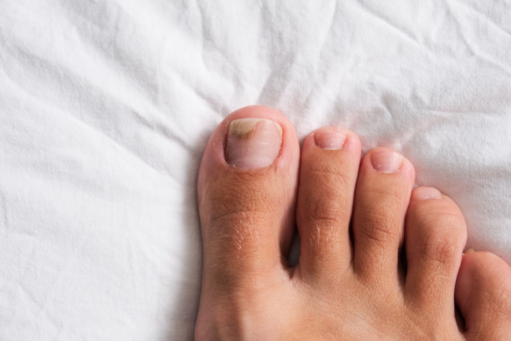 Understanding Toenail Fungus