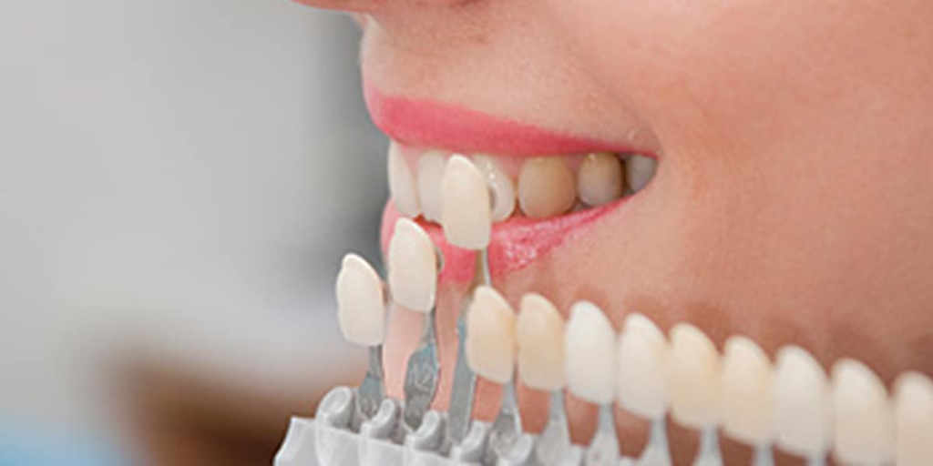 The Cost Of Dental Veneers 