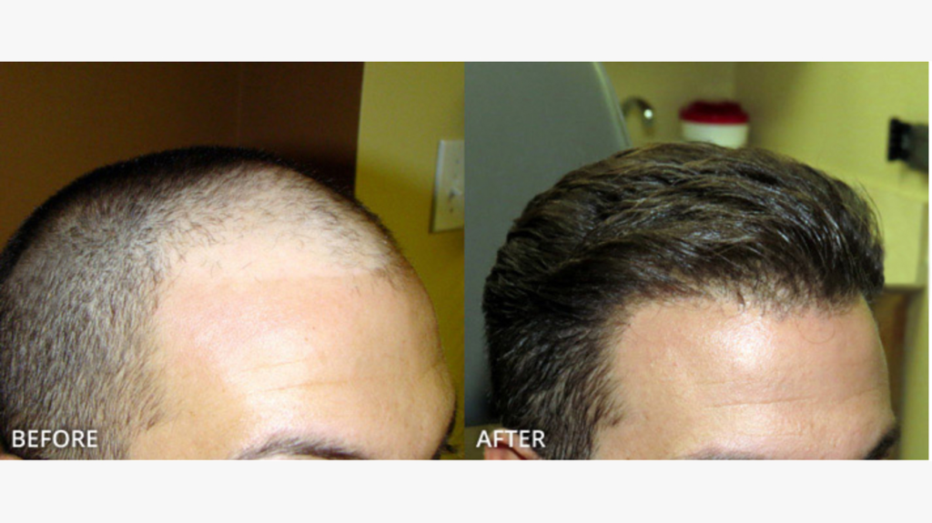 What Is A Hair Transplant?