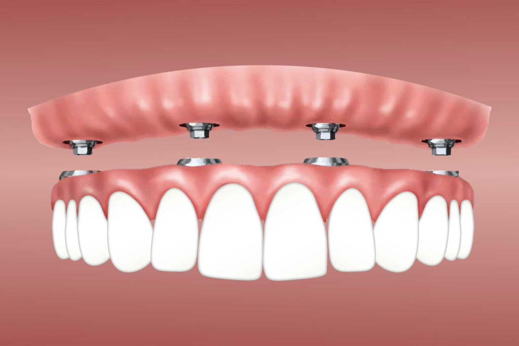 Dental Implant Procedure Isn’t Painful