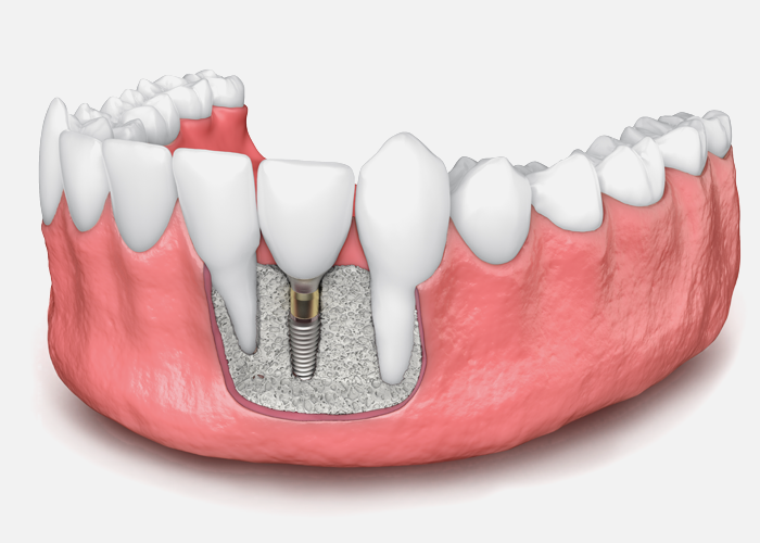 Dental Implants May Not Require Bone Grafts