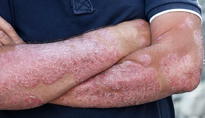 What is Psoriasis