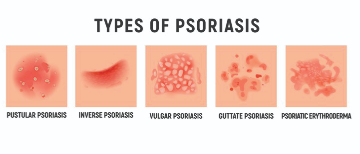Common Types of Psoriasis 