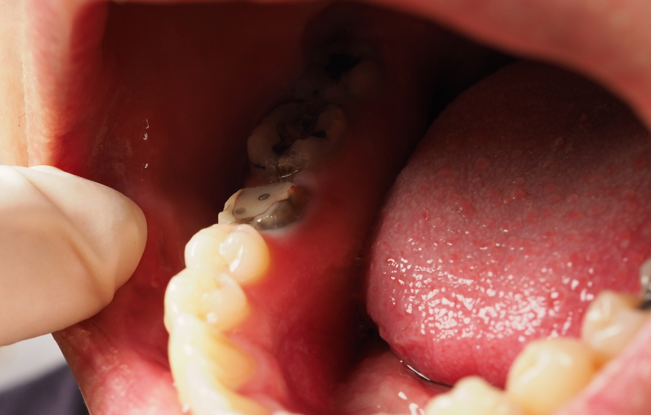 What is the timeframe for feeling better after removing the amalgam?