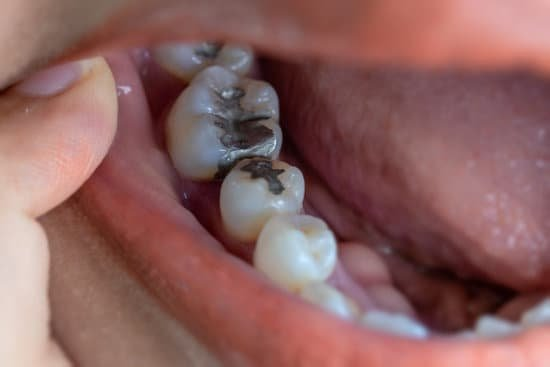 The Risks of Amalgam Fillings