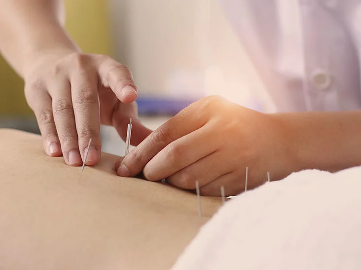Acupuncture can help you feel better