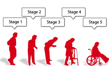 Stages of Progression of Parkinson's Disease