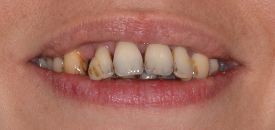 Stage 5- Refractory Periodontal