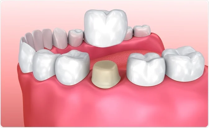 What Is A Dental Crown