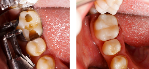 The Differences Between Crown vs. Filling