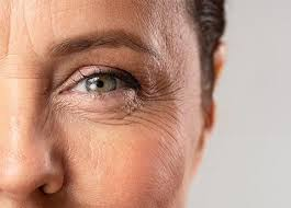 What Causes Wrinkles?