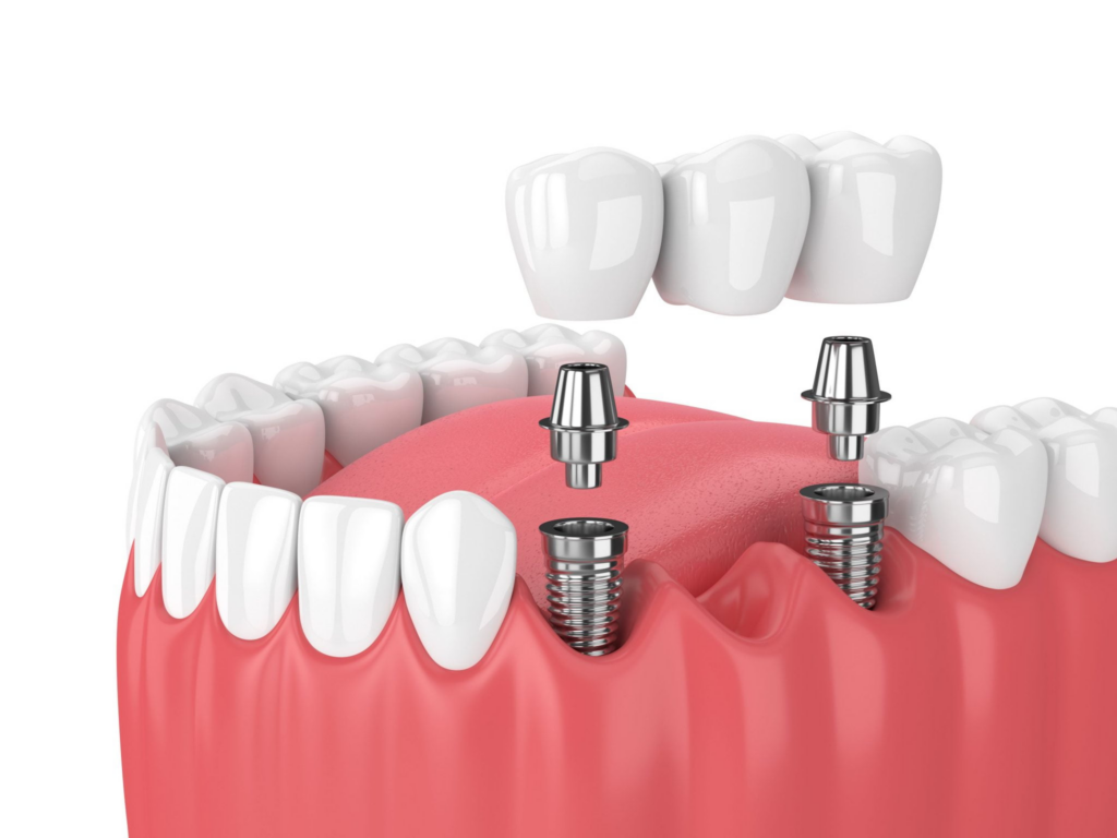 Mini Dental Implants: A Small Solution with Big Benefits