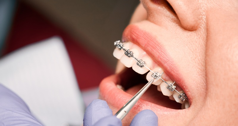 What to Expect When You Get Braces Fitted at the Orthodontist 
