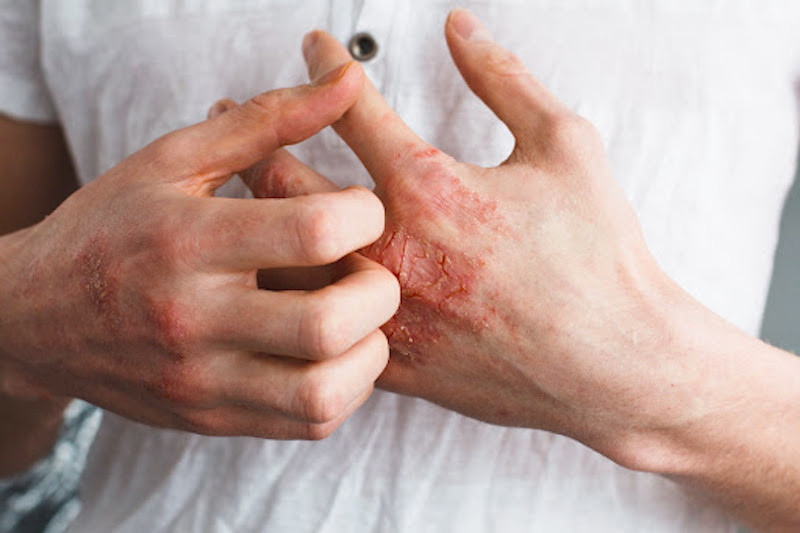 What is eczema and what causes it