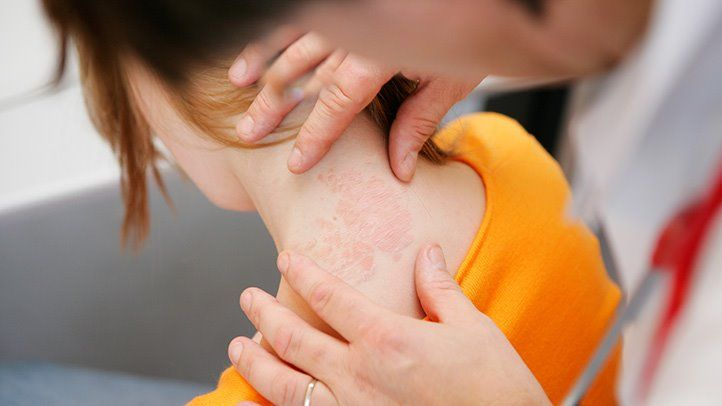 Managing Eczema Daily