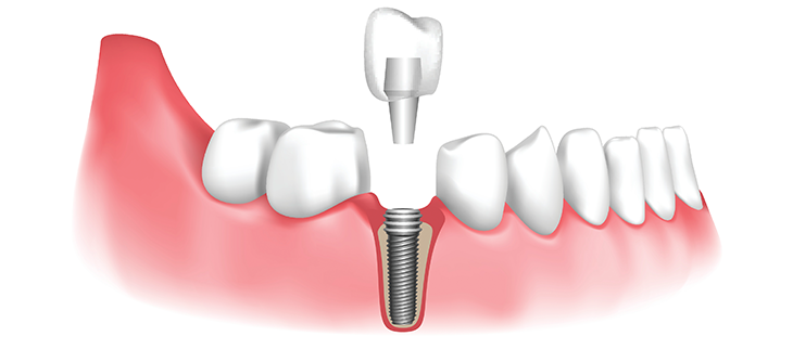 The Fundamental Role of Dental Implants