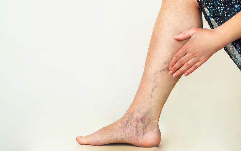 Understanding Vein Conditions