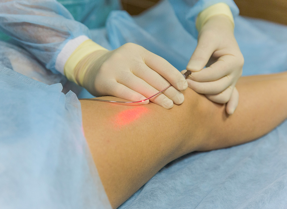 Laser Treatments for Vein Conditions